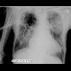 Loculated pleural fluid, aneurysm of left ventricle, apical and thrombosed, pneumothorax: X-ray - Plain radiograph